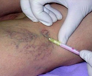 injection--varicose veins