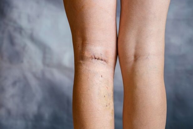 nail on the leg after surgery for varicose veins
