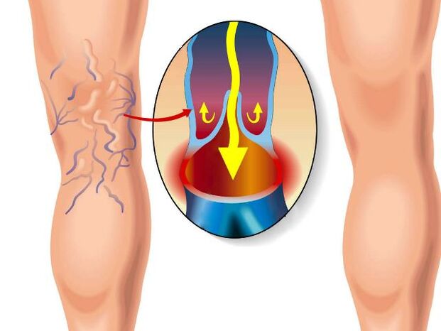 healthy bones and varicose veins in the leg