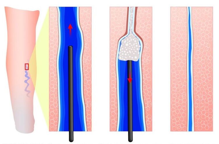 sclerotherapy for varicose veins in the labia