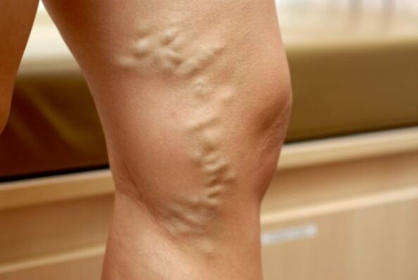 varicose veins on the leg with varicose veins in the small pelvis