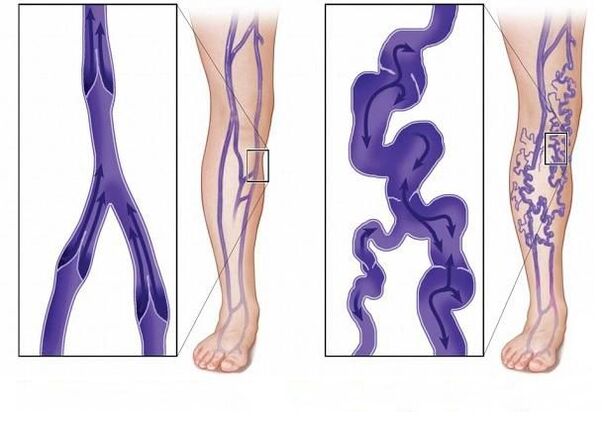 normal vein flaps and flaps with varicose veins