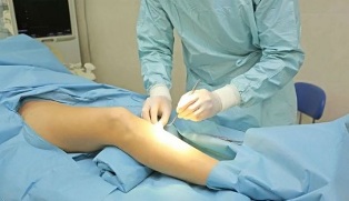 how to perform the operation for varicose veins