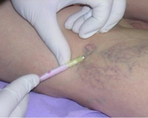 the pain of varicose veins lotions treatment