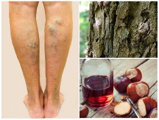treatment varicose veins varicose veins on the feet of the people means