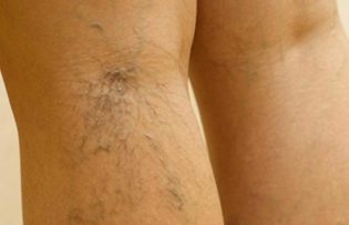 treatment varicose veins on the legs
