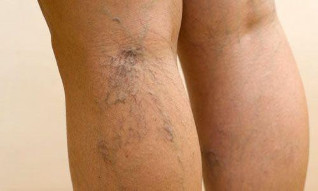 varicose veins in the legs
