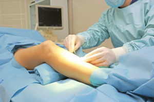 Surgery varicose veins