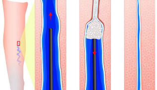 Introduction sclerosant than sclerotherapy